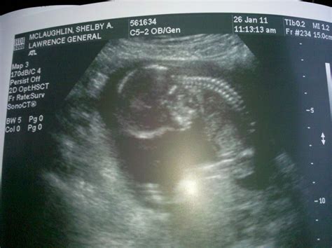 The McLaughlin Family: 15 Weeks 5 Days Ultrasound
