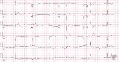 Third Degree Atrioventricular Block | ECG Stampede