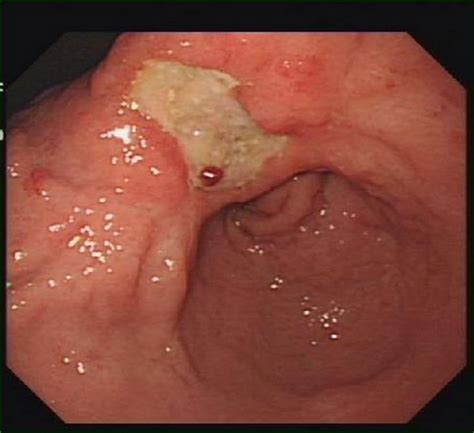 胃部火山口状溃疡图片