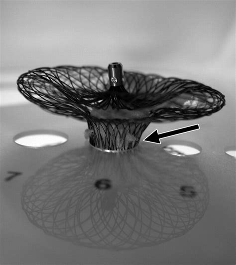 MDCT Evaluation After Closure of Atrial Septal Defect with an Amplatzer Septal Occluder | AJR
