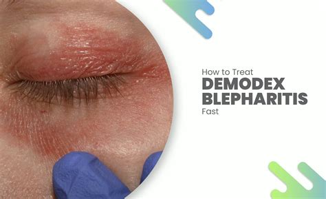 How to Treat Demodex Blepharitis Fast: What Nobody Tells You About This Eye Mite Problem - IverCares