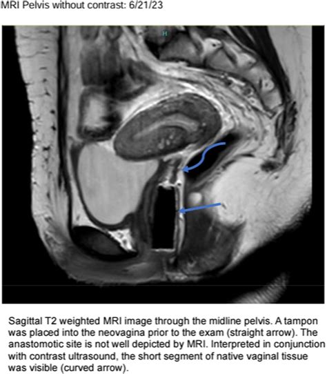 33. Contrast-Enhanced Ultrasound for Evaluation of Vaginal Stenosis - Journal of Pediatric and ...