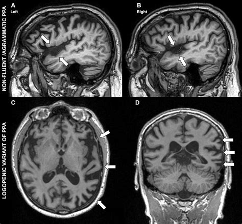 Neuroimaging in Dementia: More than Typical Alzheimer Disease | Radiology