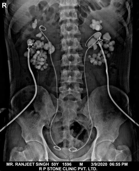 Kidney Stent Surgery Recovery Time