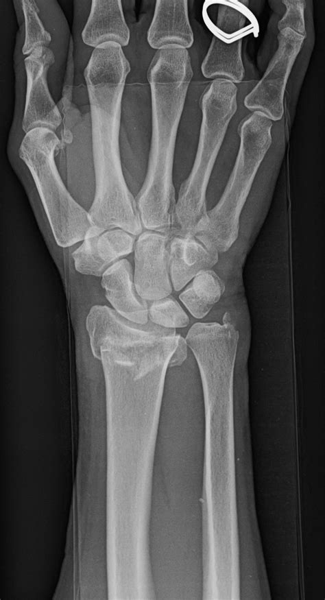Broken Wrist Treatment in Raleigh, NC - John Erickson, MD