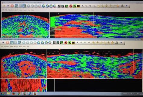 Nuevo ensayo clínico para investigar la aplicación de células madre en ...