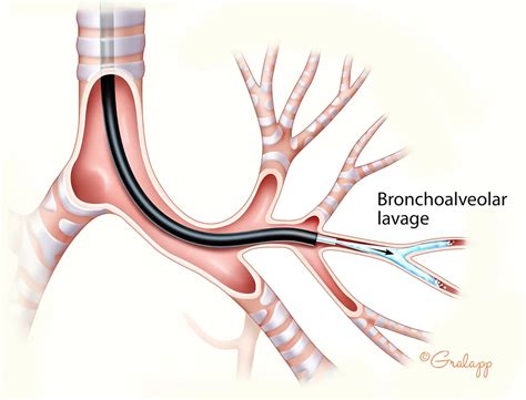 Certified Medical illustrator Chris Gralapp: Medical Illustrations ...