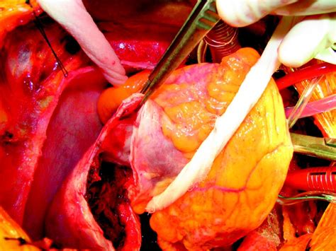 Left ventricular aneurysm and differential diagnosis with ...
