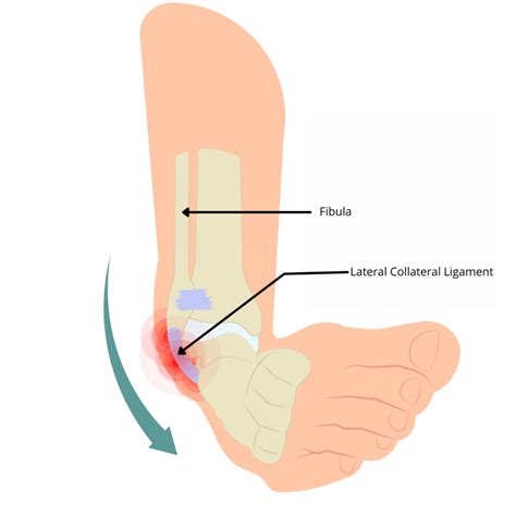 Anterior Tibiofibular Ligament Sprain