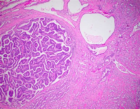 Prostate Adenocarcinoma Histology