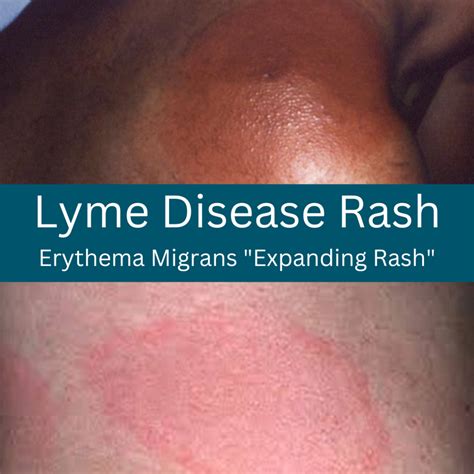 Lyme Disease Bulls Eye Skin Rashes Bay Area Lyme Foundation