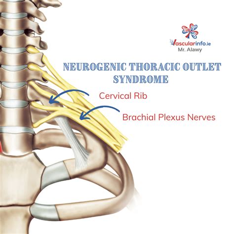 The Diagnosis Of Thoracic Outlet Syndrome – VBCTN