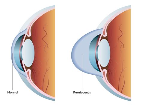Keratoconus - Kalamazoo Ophthalmology - Kalamazoo Ophthalmology