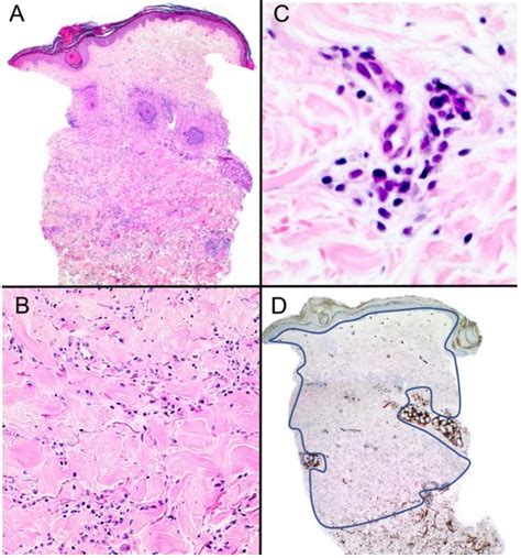 Loss of CD34 Expression within an Interstitial Dermal Lymphoid Cell ...