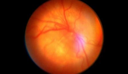 Vision problems in newborns are easily detected — and easily explained ...