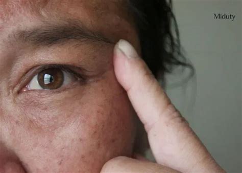 Post-Inflammatory Hyperpigmentation - Causes and Cure - Miduty