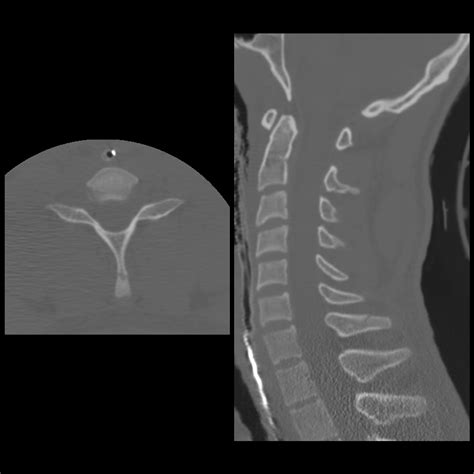 Clay Shovelers Fracture Spinous Process – Earth's Lab
