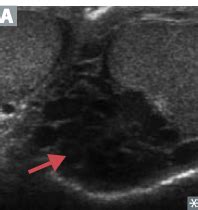 scrotal disease Flashcards | Quizlet