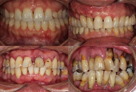 2023-09-15th/16th – Non-surgical Management of Periodontal Disease – Dental Artistry Academy