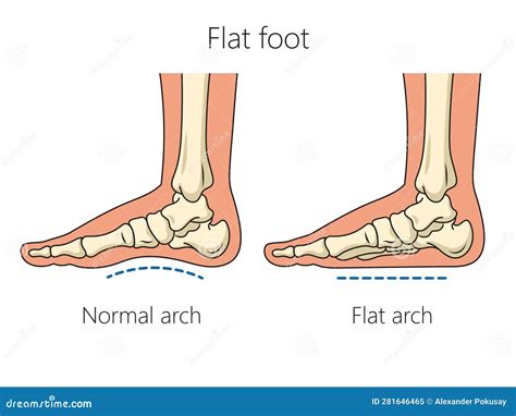Flat Feet Anatomy Vector Illustration | CartoonDealer.com #287967676