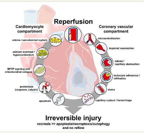 Myocardial Ischemia: From Disease To Syndrome – DQUSC