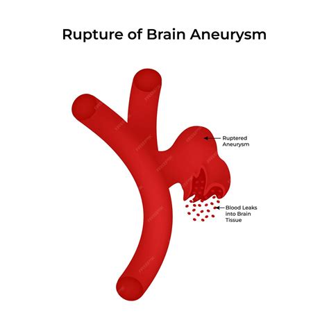 Premium Vector | Rupture of Brain Aneurysm Ruptured Aneurysm Blood ...