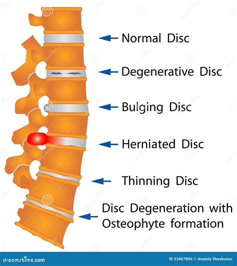 Disc Degeneration With Osteophyte Formation at Dorothy Boots blog