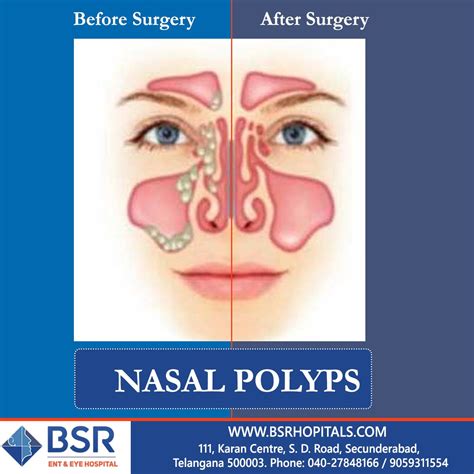 What Does A Polyp Look Like In Your Nose at Ruth Leet blog