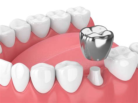 Metal Crown Front Tooth | Supreme Dental