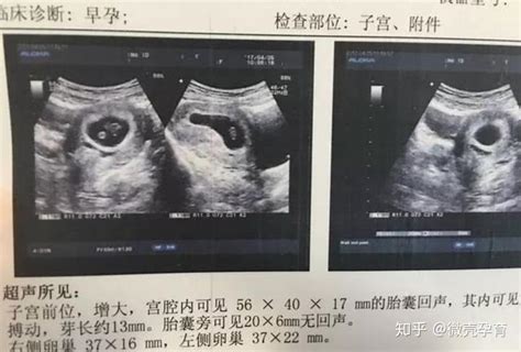 孕3月男女胎儿个性藏得深，摸清B超这几个数据，胎儿就没啥秘密了 - 百度宝宝知道