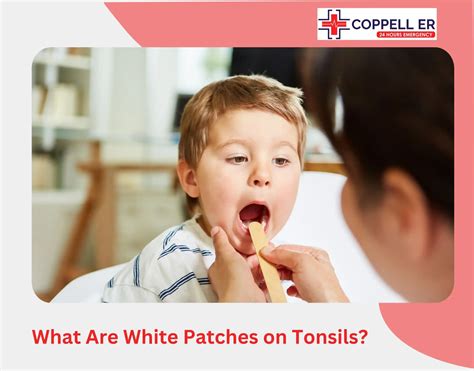 White Patches on Tonsils: See Causes and Treatment Options