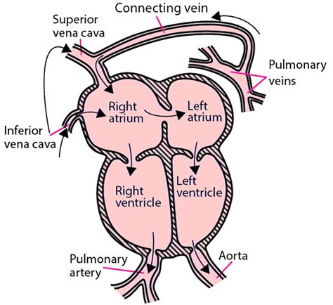 Image:Total Anomalous Pulmonary Venous Return-MSD Manual Consumer Version