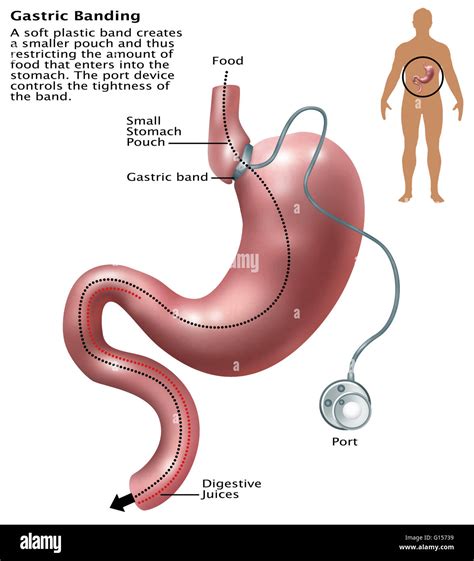 Illustration of gastric banding. A laparoscopic adjustable gastric band, commonly called a lap ...