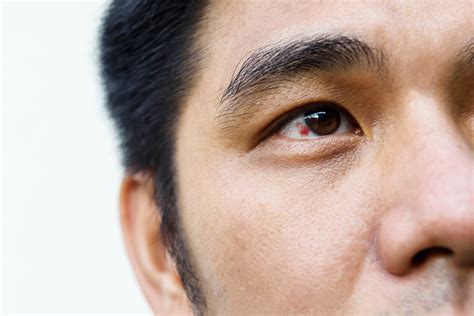 Sangre en el ojo…. Derrame Ocular