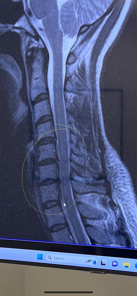 Please help! 3 bulging discs in my neck (C5, C6,C7)with excruciating ...