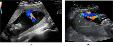 Clinically Relevant Prenatal Ultrasound Diagnosis of Umbilical Cord ...