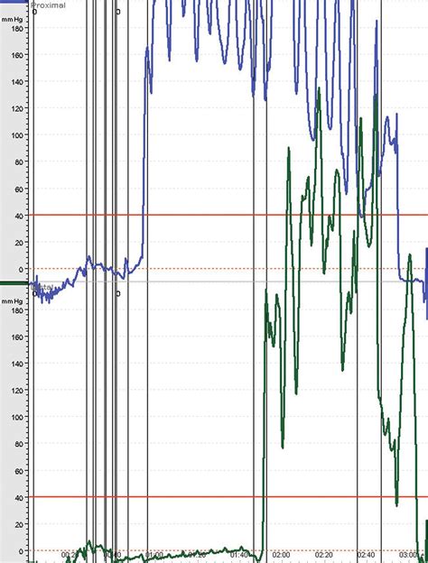 Biliary Dyskinesia and Sphincter of Oddi Dysfunction - Clinical Tree
