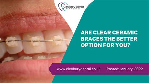 Are Clear Ceramic Braces The Better Option For You? - Cleobury Dental Practice