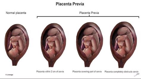 PLACENTA ACCRETA SPECTRUM DISORDERS.pptx