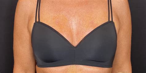 Vampire Breast Lift Milwaukee | RemedyNow Aesthetics - breast lift results