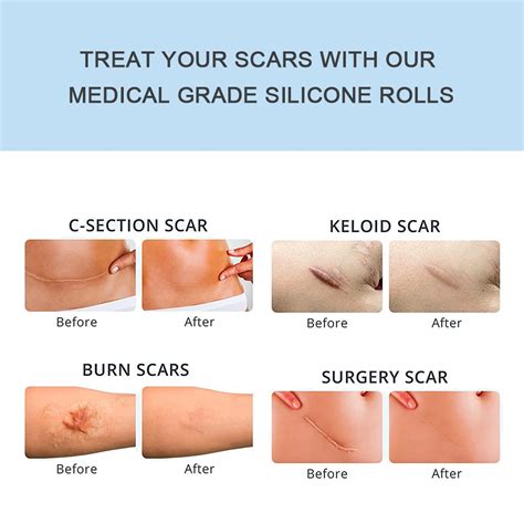 Keloid Scar C Section