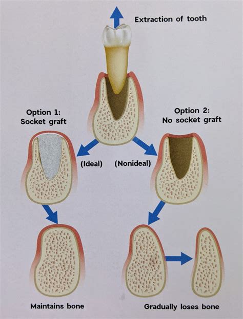 Bone Loss In Teeth