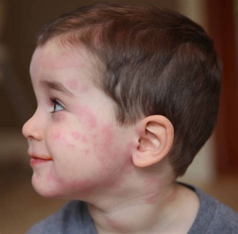 Red Patches on Face, Causes and Remedies