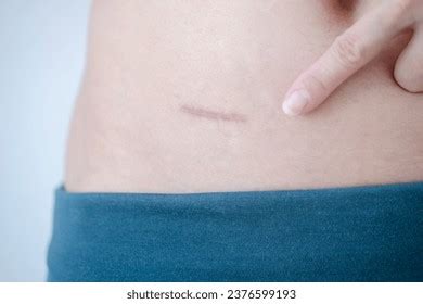 Image result for Appendix Surgery Scar