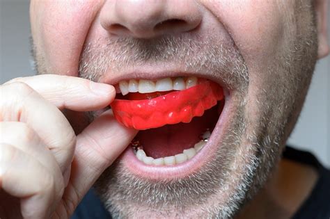 The Role of Mouthguards In the Prevention of Dental Injuries - He and ...