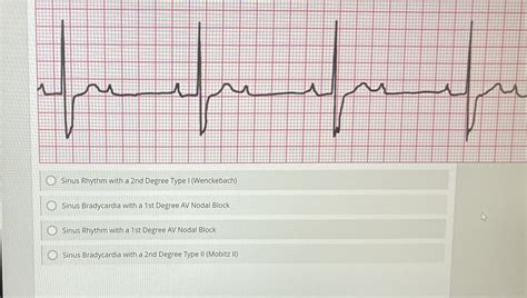Solved Sinus Rhythm with a 2nd Degree Type I | Chegg.com