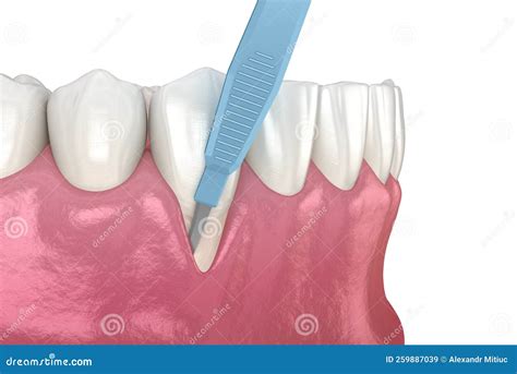 Gum Recession: Soft Tissue Graft Surgery. 3D Illustration of Dental Treatment Stock Illustration ...