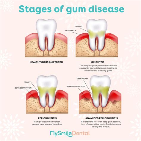 Stages of gum disease - MySmile Dental Clinic