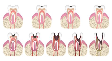 Premium Vector | Stages of caries development tooth structure in flat style tooth decay with ...