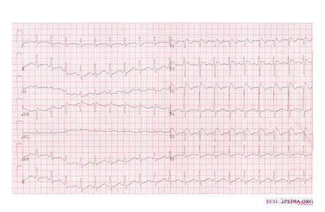 Brugada syndrome electrocardiographic examples of Type I Brugada syndrome - wikidoc